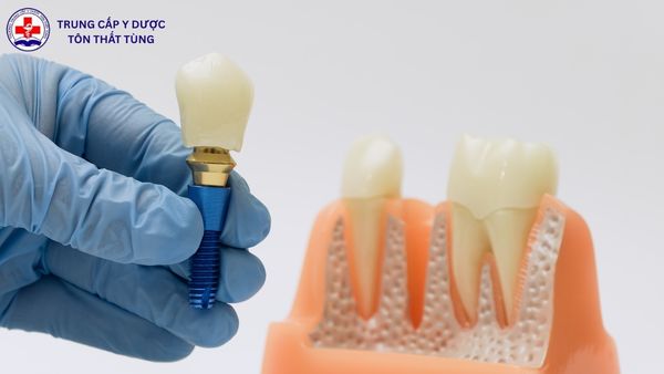 Kỹ thuật phục hình răng điểm chuẩn bao nhiêu? Cập nhật mới 2026 kỹ thuật phục hình răng điểm chuẩn