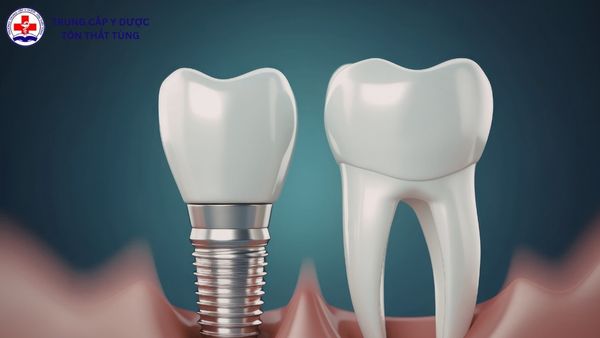 Kỹ thuật phục hình răng là gì? Hiểu đúng về ngành nghề trong nha khoa kỹ thuật phục hình răng là gì